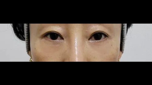 Partial Incision Double Eyelid Surgery, Lower Eyelid Fat Grafting, Lower Blepharoplasty (Aging Eye Rejuvenation) — RE&RE PLASTIC SURGERY 2