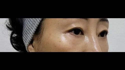 Partial Incision Double Eyelid Surgery, Lower Eyelid Fat Grafting, Lower Blepharoplasty (Aging Eye Rejuvenation) — RE&RE PLASTIC SURGERY 3