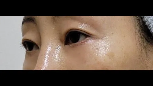 Partial Incision Double Eyelid Surgery, Lower Eyelid Fat Grafting, Lower Blepharoplasty (Aging Eye Rejuvenation) — RE&RE PLASTIC SURGERY 4