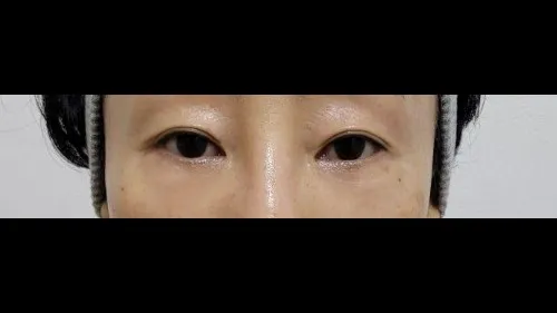 Partial Incision Double Eyelid Surgery, Lower Eyelid Fat Grafting, Lower Blepharoplasty (Aging Eye Rejuvenation) — RE&RE PLASTIC SURGERY 5