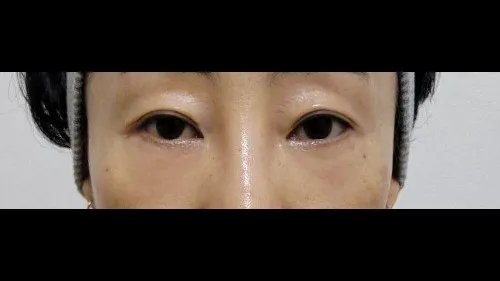 Partial Incision Double Eyelid Surgery, Lower Eyelid Fat Grafting, Lower Blepharoplasty (Aging Eye Rejuvenation) — RE&RE PLASTIC SURGERY 6