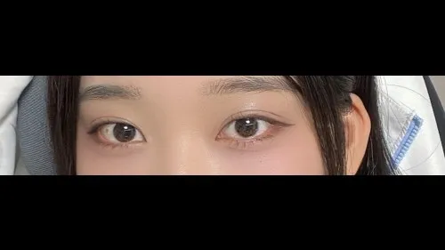 Natural Adhesion Double Eyelid Surgery, Ptosis Correction, Lower Eyelid Fat Repositioning — RE&RE PLASTIC SURGERY 2