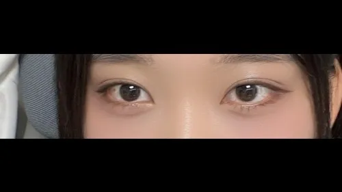 Natural Adhesion Double Eyelid Surgery, Ptosis Correction, Lower Eyelid Fat Repositioning — RE&RE PLASTIC SURGERY 3