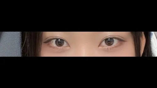Natural Adhesion Double Eyelid Surgery, Ptosis Correction, Lower Eyelid Fat Repositioning — RE&RE PLASTIC SURGERY 4