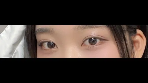 Natural Adhesion Double Eyelid Surgery, Ptosis Correction, Lower Eyelid Fat Repositioning — RE&RE PLASTIC SURGERY 5