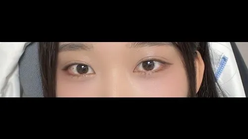 Natural Adhesion Double Eyelid Surgery, Ptosis Correction, Lower Eyelid Fat Repositioning — RE&RE PLASTIC SURGERY 6