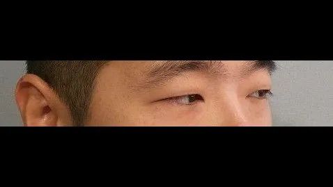 Incisional Double Eyelid Surgery, Ptosis Correction — RE&RE PLASTIC SURGERY 2