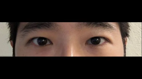 Incisional Double Eyelid Surgery, Ptosis Correction — RE&RE PLASTIC SURGERY 3