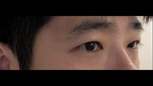 Incisional Double Eyelid Surgery, Ptosis Correction — RE&RE PLASTIC SURGERY 4