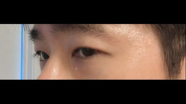 Incisional Double Eyelid Surgery, Ptosis Correction — RE&RE PLASTIC SURGERY 5