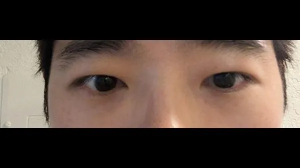 Incisional Double Eyelid Surgery, Ptosis Correction — RE&RE PLASTIC SURGERY 6
