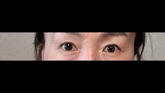 Sub-brow Lift, Ptosis Correction — RE&RE PLASTIC SURGERY 2