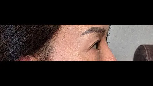 Sub-brow Lift, Ptosis Correction — RE&RE PLASTIC SURGERY 4