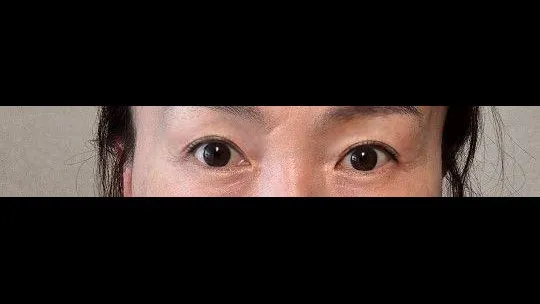 Sub-brow Lift, Ptosis Correction — RE&RE PLASTIC SURGERY 5