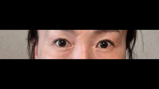 Sub-brow Lift, Ptosis Correction — RE&RE PLASTIC SURGERY 6