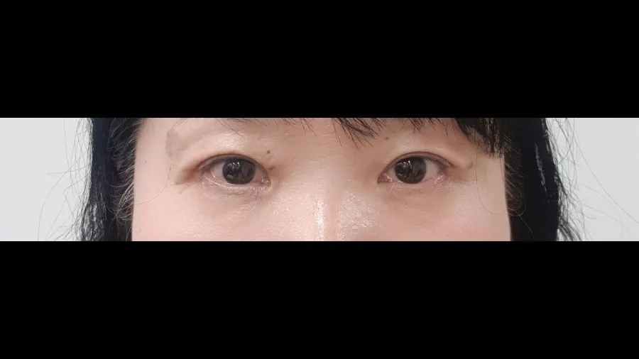 Sub-brow Lift — RE&RE PLASTIC SURGERY 2
