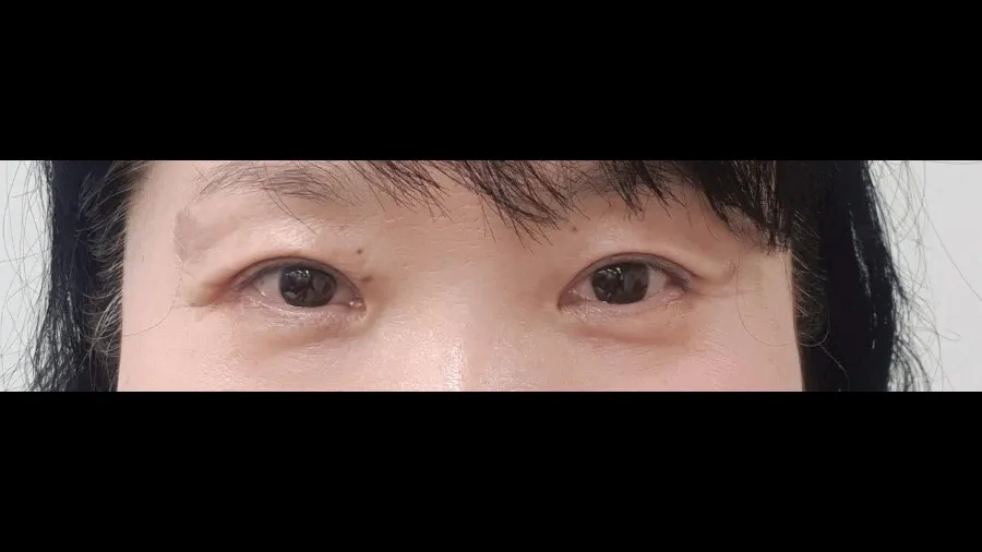 Sub-brow Lift — RE&RE PLASTIC SURGERY 3