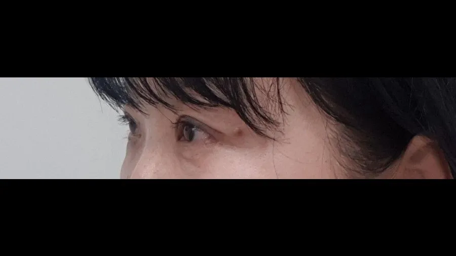 Sub-brow Lift — RE&RE PLASTIC SURGERY 4