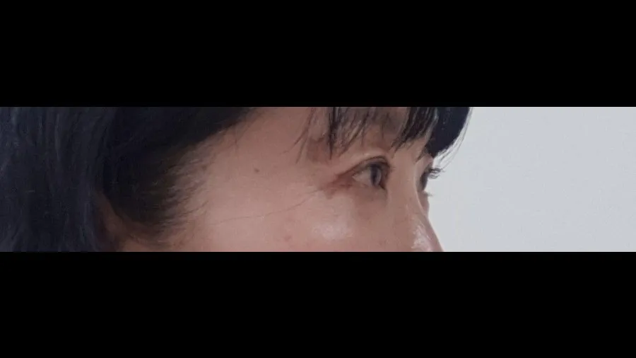 Sub-brow Lift — RE&RE PLASTIC SURGERY 5
