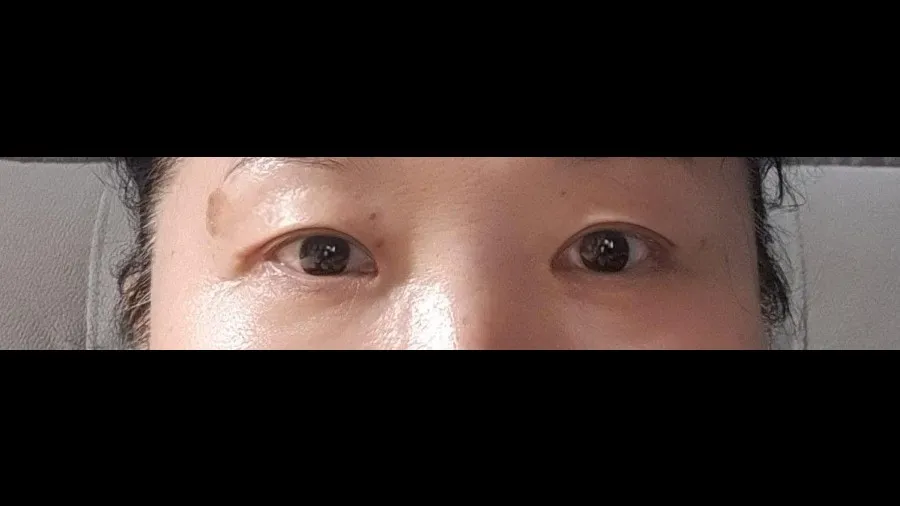 Sub-brow Lift — RE&RE PLASTIC SURGERY 6