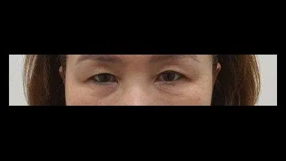Sub-brow Lift, Nasal Tip — RE&RE PLASTIC SURGERY 1