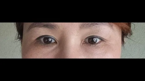 Sub-brow Lift, Nasal Tip 2