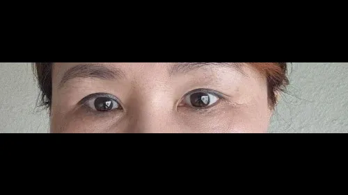 Sub-brow Lift, Nasal Tip — RE&RE PLASTIC SURGERY 3