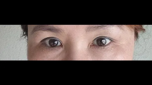 Sub-brow Lift, Nasal Tip — RE&RE PLASTIC SURGERY 4