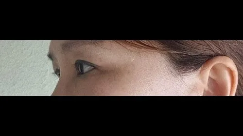 Sub-brow Lift, Nasal Tip — RE&RE PLASTIC SURGERY 5