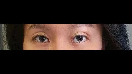 部分切開二重術, 目つき矯正, 目つき矯正再手術 — RE&RE PLASTIC SURGERY 1