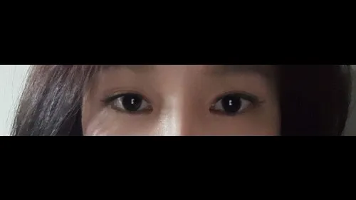 部分切開二重術, 目つき矯正, 目つき矯正再手術 — RE&RE PLASTIC SURGERY 4