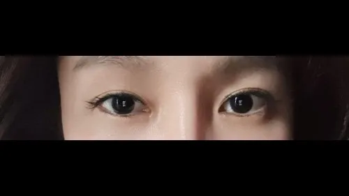 部分切開二重術, 目つき矯正, 目つき矯正再手術 — RE&RE PLASTIC SURGERY 5