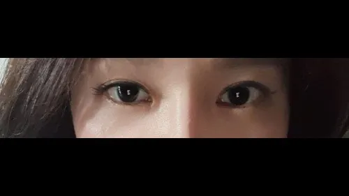部分切開二重術, 目つき矯正, 目つき矯正再手術 — RE&RE PLASTIC SURGERY 6