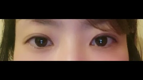 Partial Incision Double Eyelid Surgery, Ptosis Correction — RE&RE PLASTIC SURGERY 2