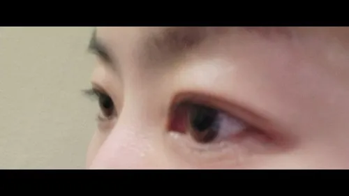 Partial Incision Double Eyelid Surgery, Ptosis Correction — RE&RE PLASTIC SURGERY 3