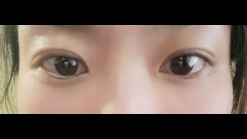 Partial Incision Double Eyelid Surgery, Ptosis Correction — RE&RE PLASTIC SURGERY 4