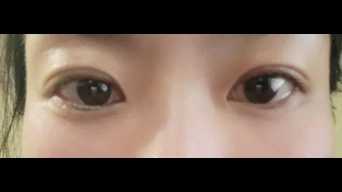 Partial Incision Double Eyelid Surgery, Ptosis Correction — RE&RE PLASTIC SURGERY 5