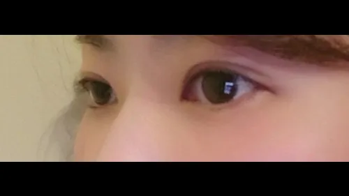Partial Incision Double Eyelid Surgery, Ptosis Correction — RE&RE PLASTIC SURGERY 6