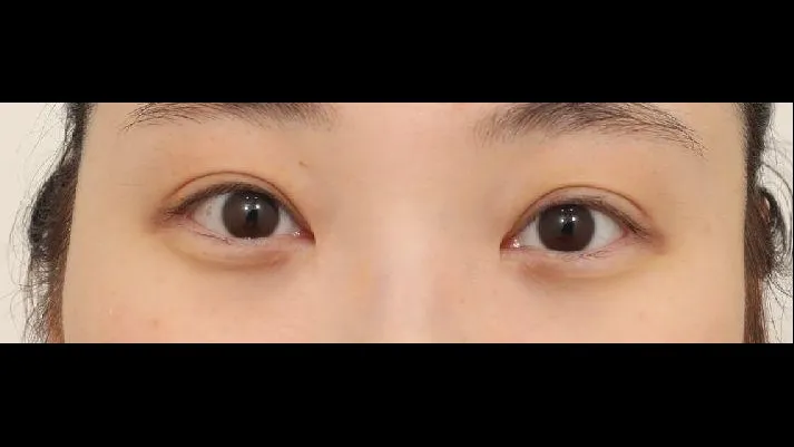 Crease lowering, Double Eyelid Crease Removal 1