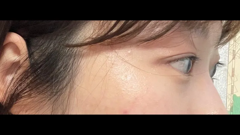 双眼皮宽度修复, 双眼皮去除 — RE&RE PLASTIC SURGERY 2