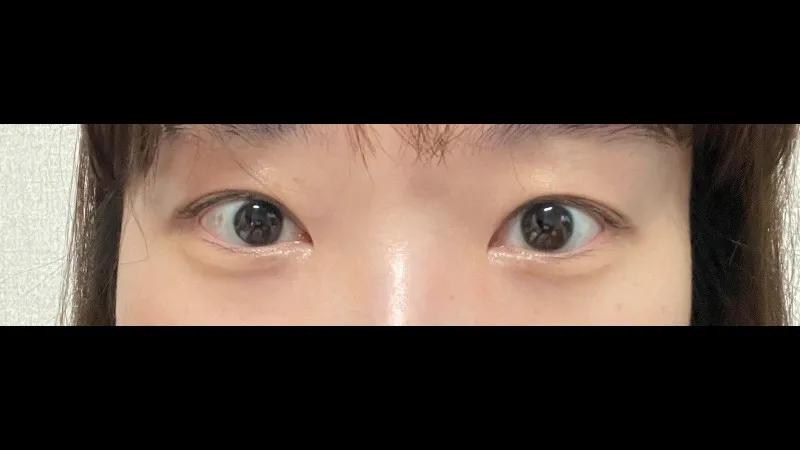 双眼皮宽度修复, 双眼皮去除 — RE&RE PLASTIC SURGERY 3