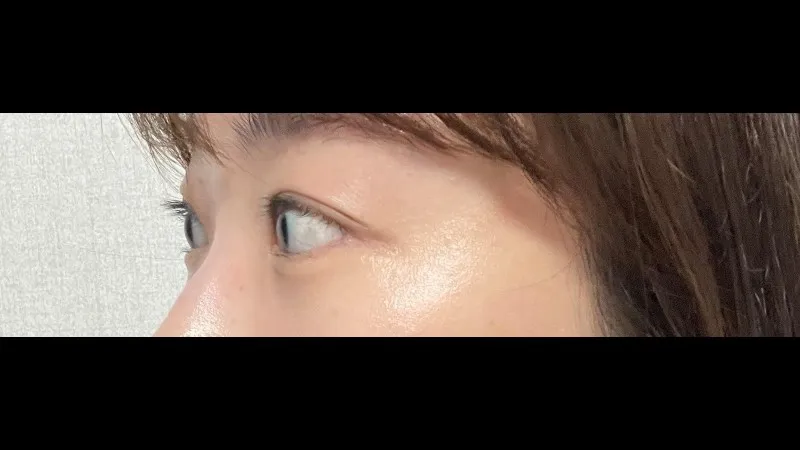 双眼皮宽度修复, 双眼皮去除 — RE&RE PLASTIC SURGERY 5
