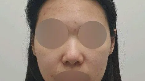 Nasal Tip 1