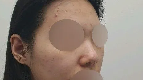 Nasal Tip 2