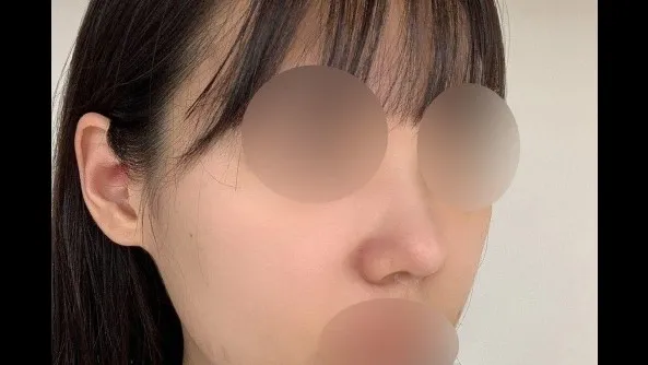 Nasal Tip — RE&RE PLASTIC SURGERY 3