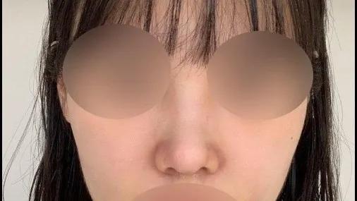 Nasal Tip — RE&RE PLASTIC SURGERY 4