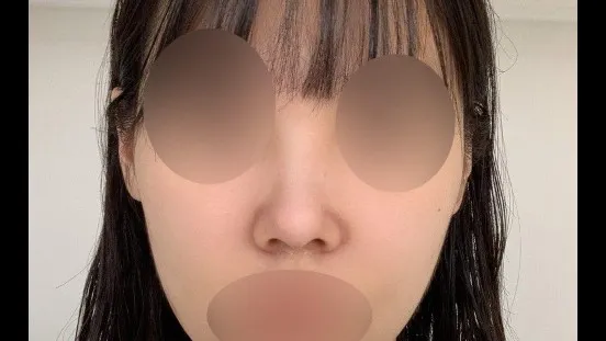 Nasal Tip — RE&RE PLASTIC SURGERY 5
