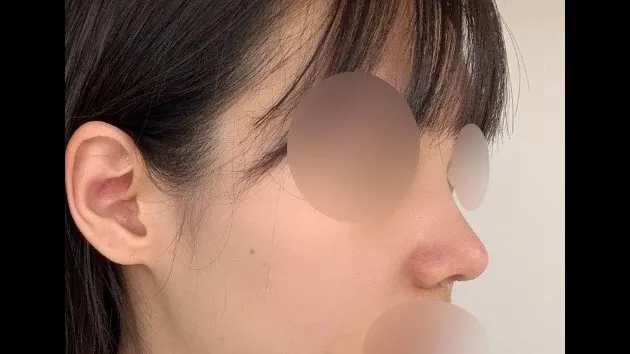 Nasal Tip — RE&RE PLASTIC SURGERY 6