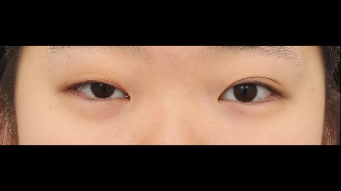 Partial Incision Double Eyelid Surgery, Ptosis Correction, Bulbous Nose, Nasal Tip, Nasal Bridge 1