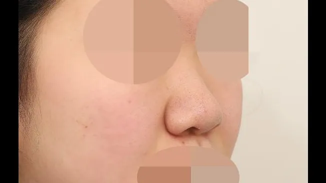 Partial Incision Double Eyelid Surgery, Ptosis Correction, Bulbous Nose, Nasal Tip, Nasal Bridge — RE&RE PLASTIC SURGERY 2